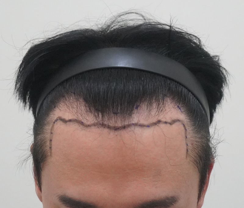 박상현 원장님 2000모 모발이식, 당일 후기 
