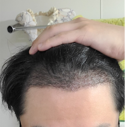 김용빈 원장님 M자 모발이식 2주차 경과 공유합니다 