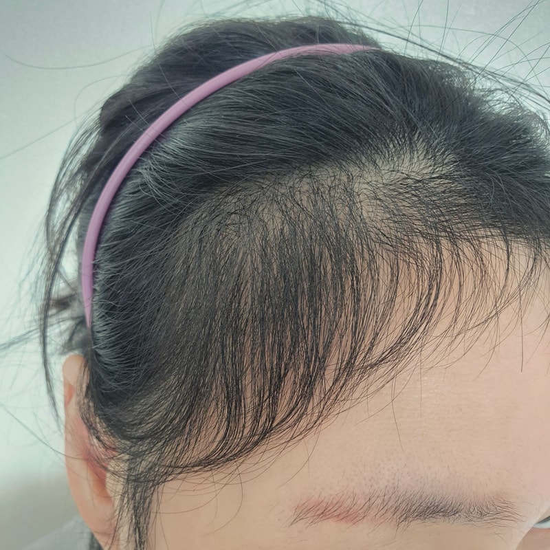 [뉴헤어] 모발이식 6개월차