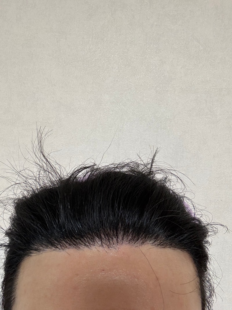 뉴헤어 비절개 모발이식 9개월 후기