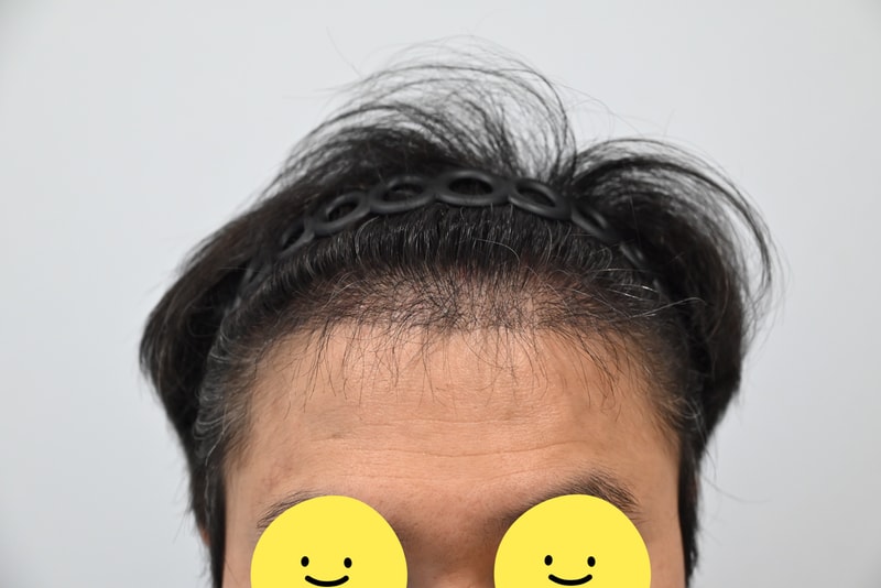 비절개 히든컷 모발이식100일차 후기