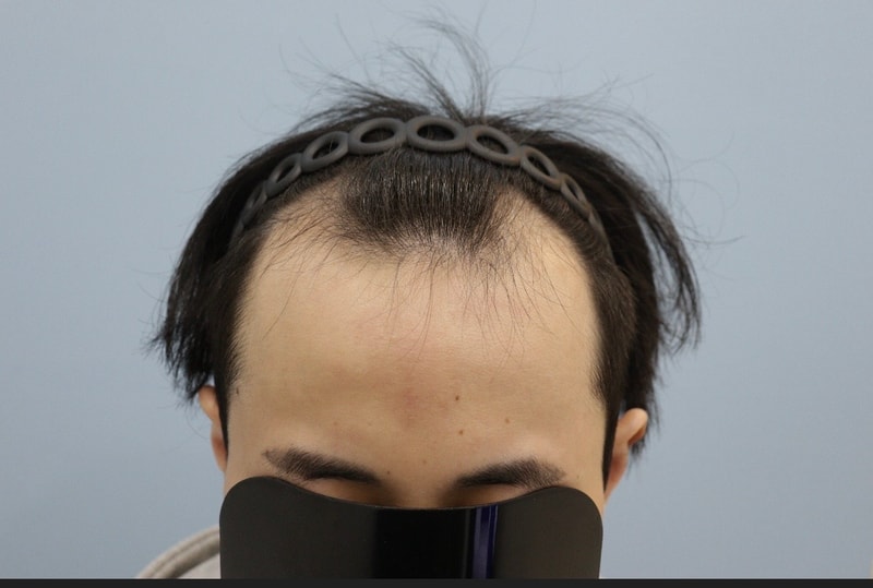 광주 압구정모비앙의원 모발이식 10개월 경과 후기