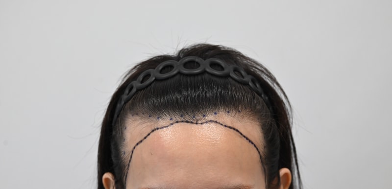 헤어라인 14일차