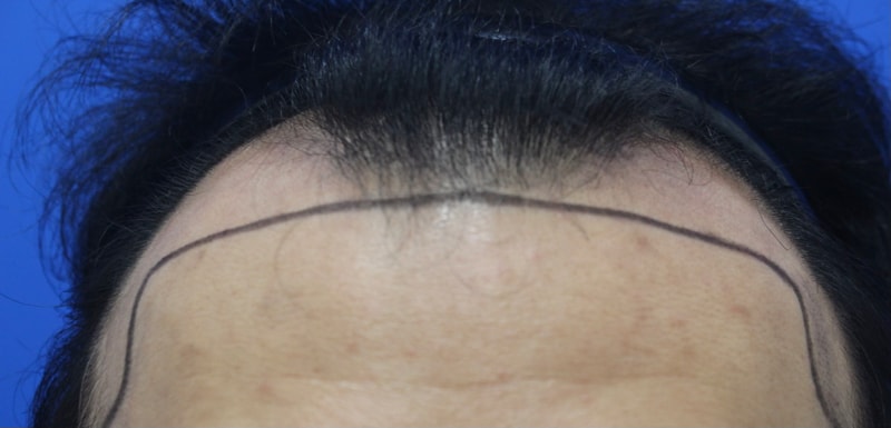 깊은 M자 5600모 모발이식 내돈내산 후기