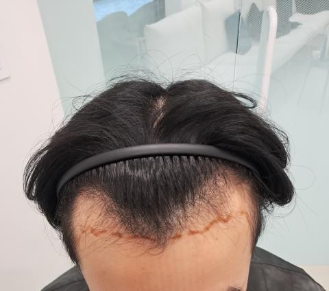 모자 많이 쓰지마세요 남성 탈모와 겹친 사연 풉니다