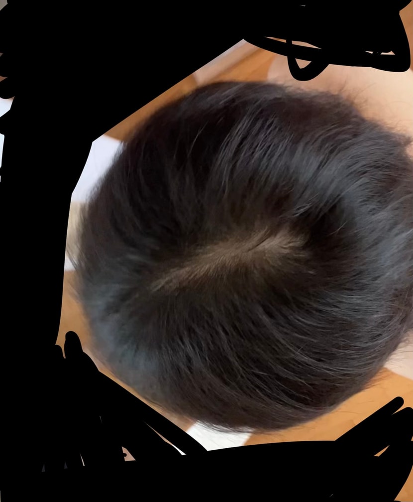 병원 가기 전 머리 상태입니다.. 빛 비추면 좀 더 심해보여요