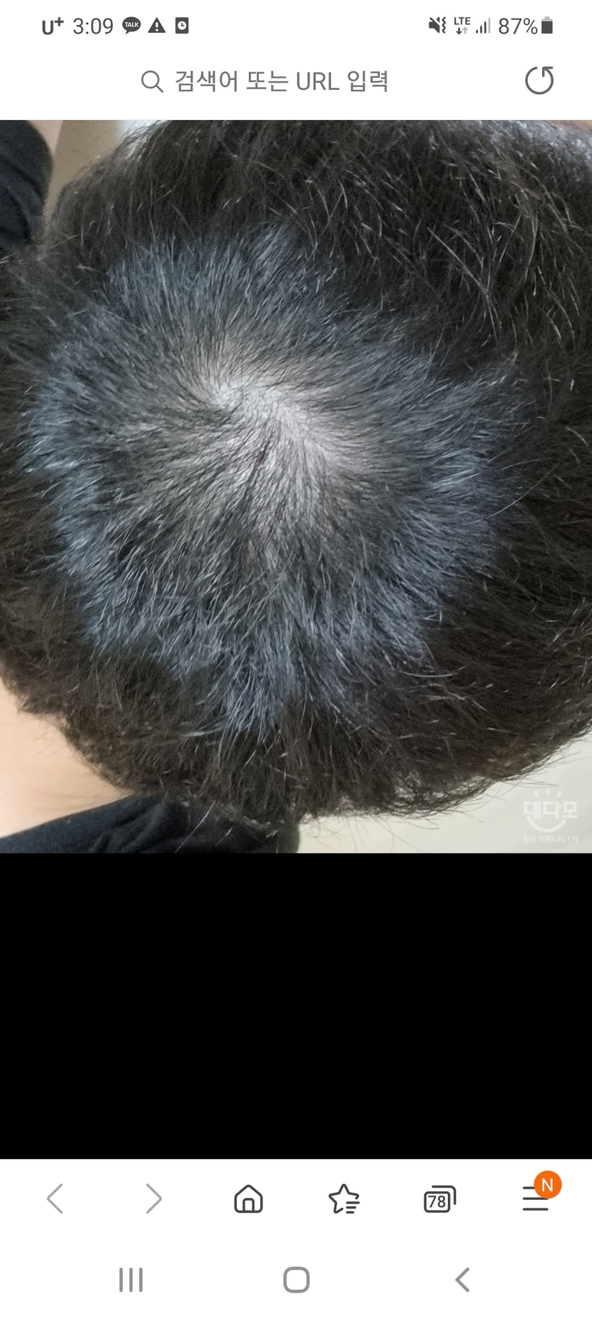 수술후