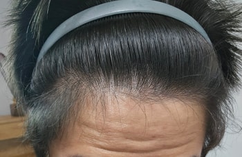 현재 22살 이마