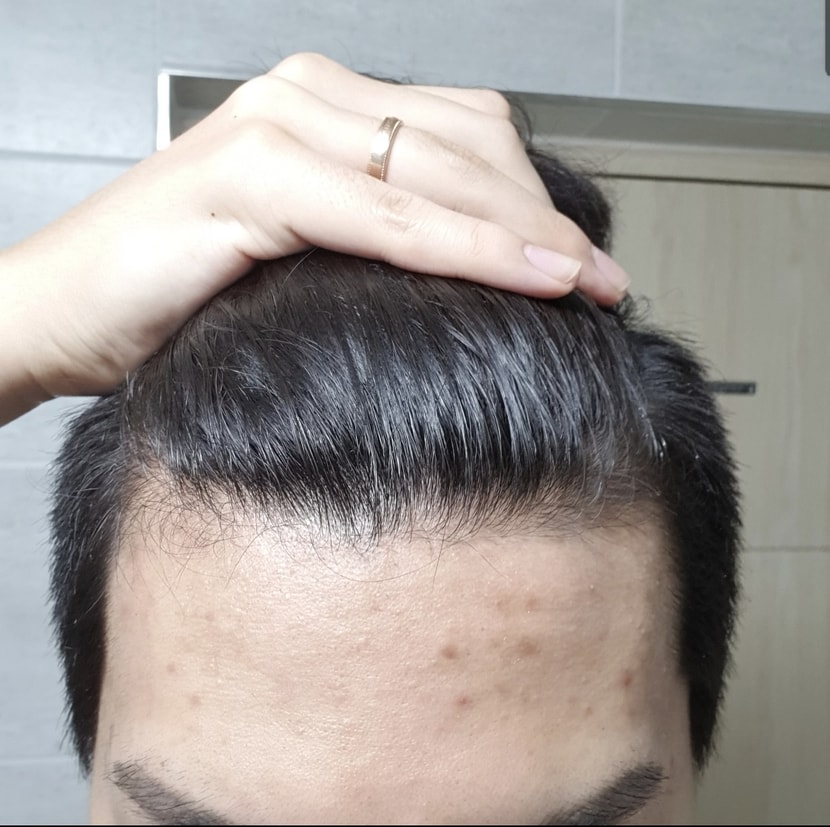 마이시아 1년 복용할때