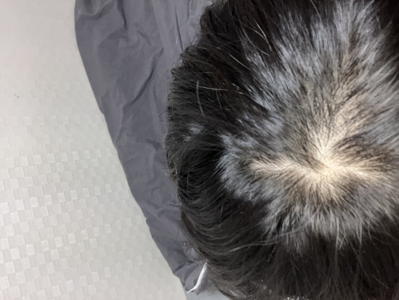 今年22歳なのに頭頂部の方がよく痩せる