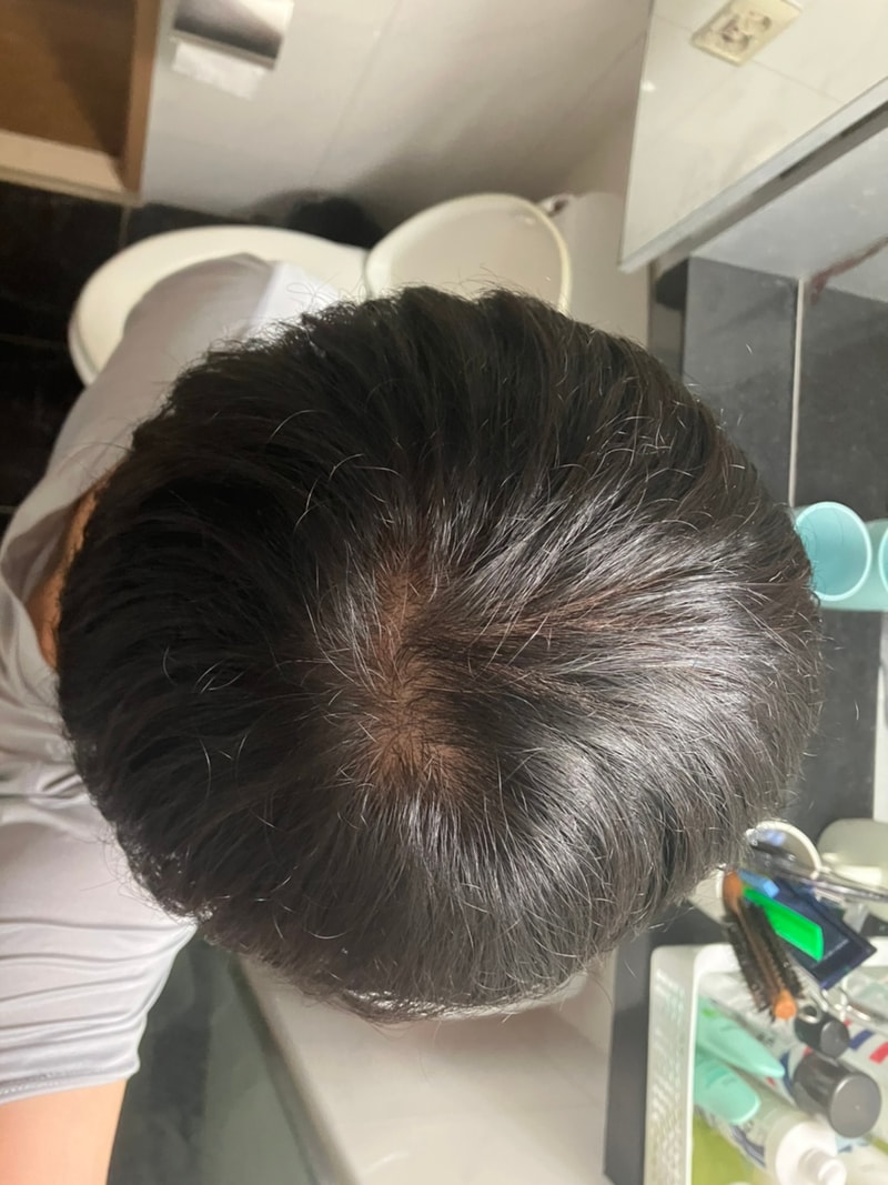 헤어그로 11개월 후기입니다