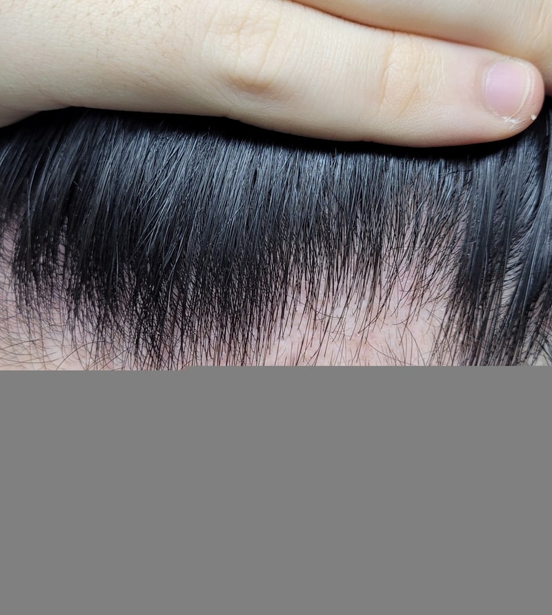 M자 프로페시아