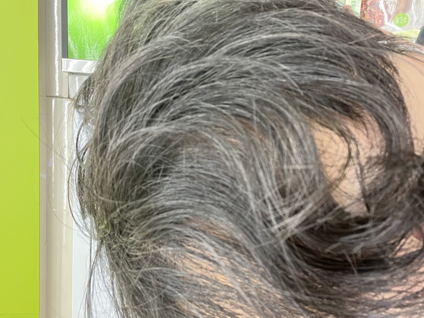 현재 앞머리 상황… 첫 번째 치료 후에는 그래도 빈곳없게 채워졌었는데….