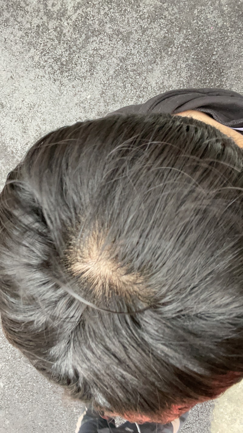 이거 탈모 맞죠..?