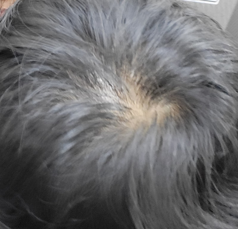 아보 3년차 너무 심해져서 모발이식 생각중인데