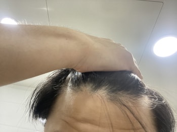 이마는 잘 못찍겠는데 m자가 좀 있어