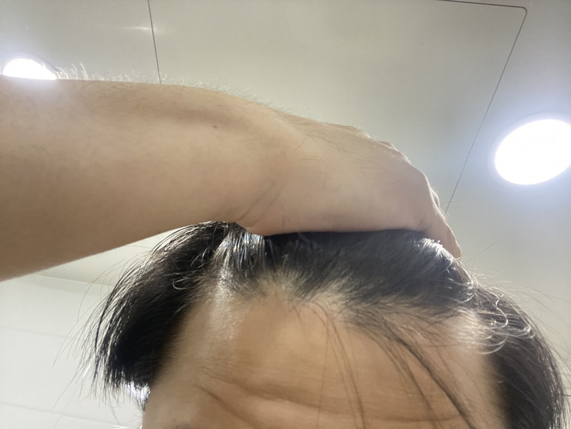 이마는 잘 못찍겠는데 m자가 좀 있어