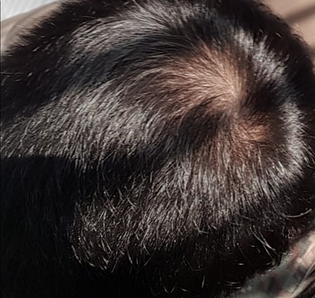 20191206, 복용 약 70일차