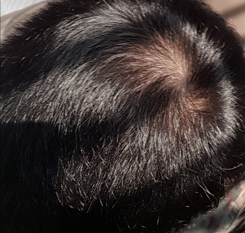 20191206, 복용 약 70일차