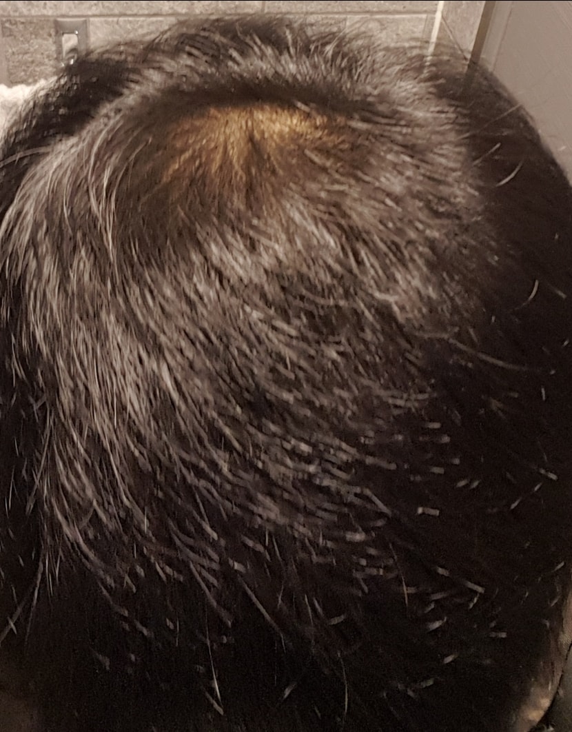 20191206, 복용 약 70일차