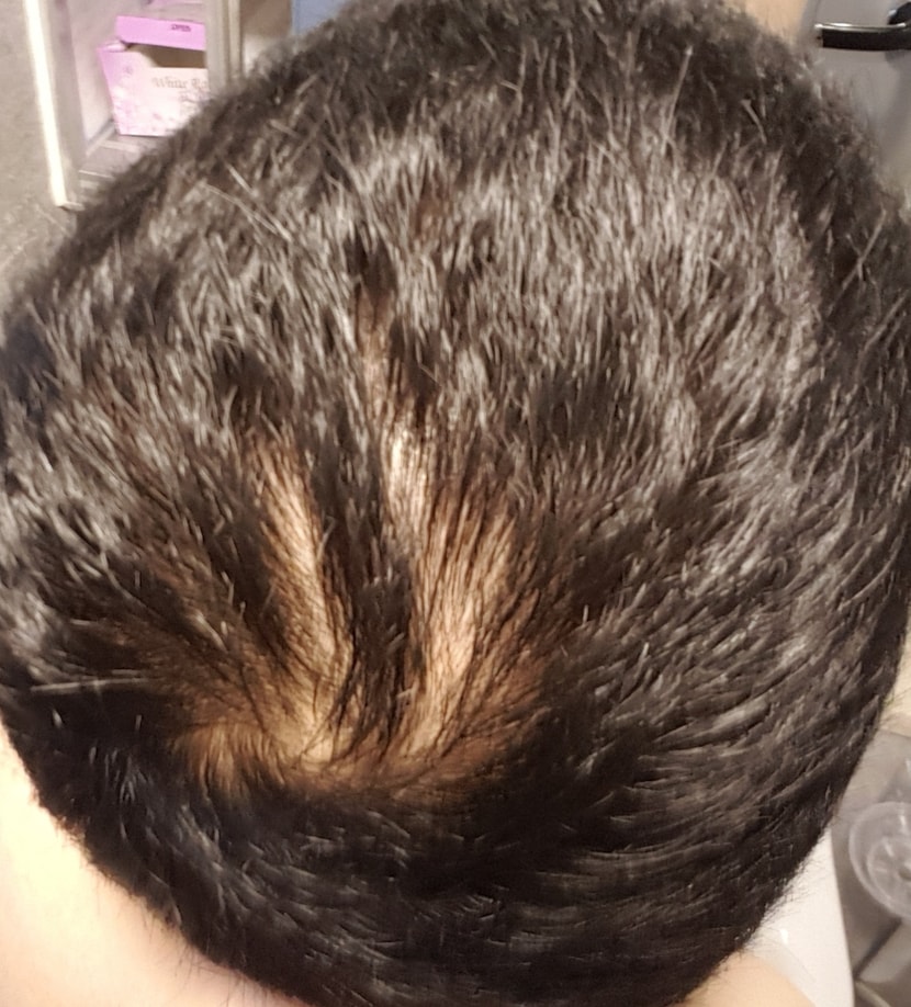 20190923, 복용 시작 전 탈모 진행 상태