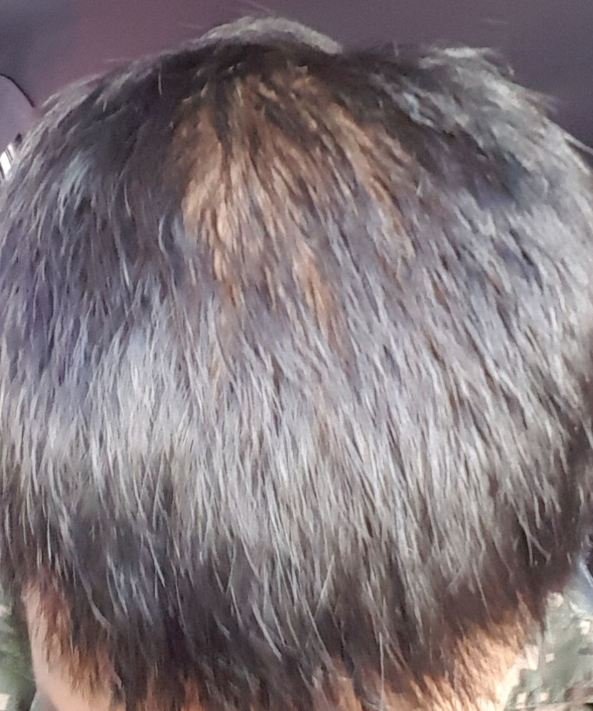 20190923, 복용 시작 전 탈모 진행 상태
