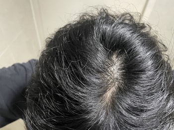 그저께 정수리