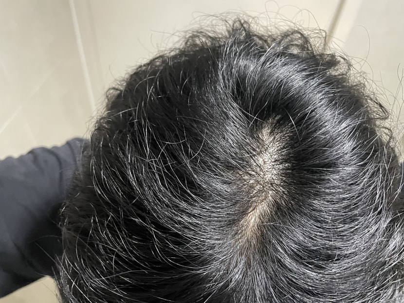 그저께 정수리