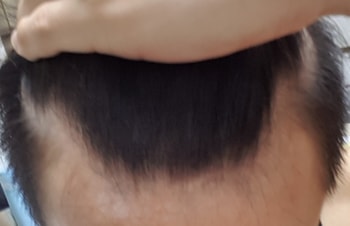 11월중순 이때 탈모 직감