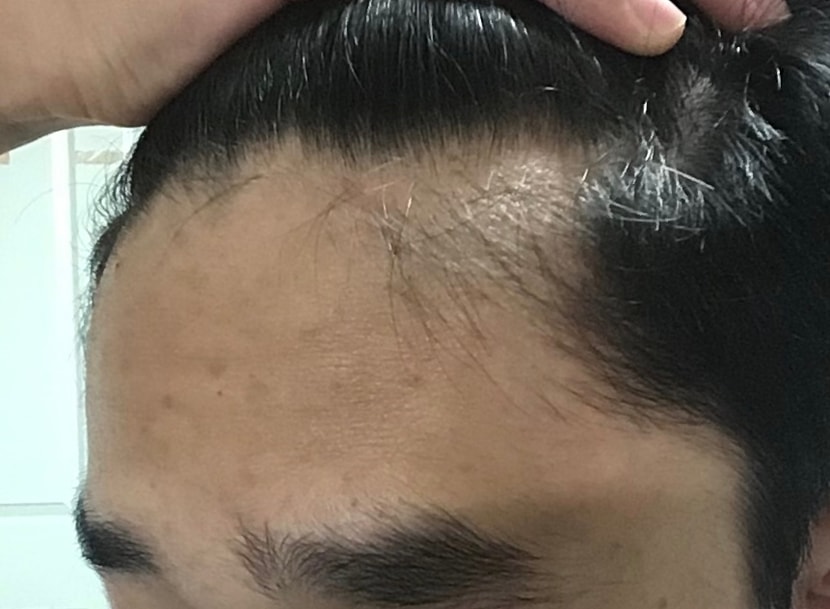 여기 보이는 잔털은 미녹시딜 바를 때 났던 거.. 거의 다 빠짐