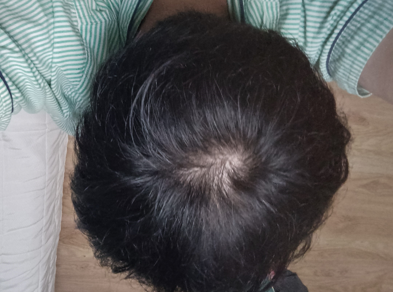 5년간 탈모 치료 노력 올린다.