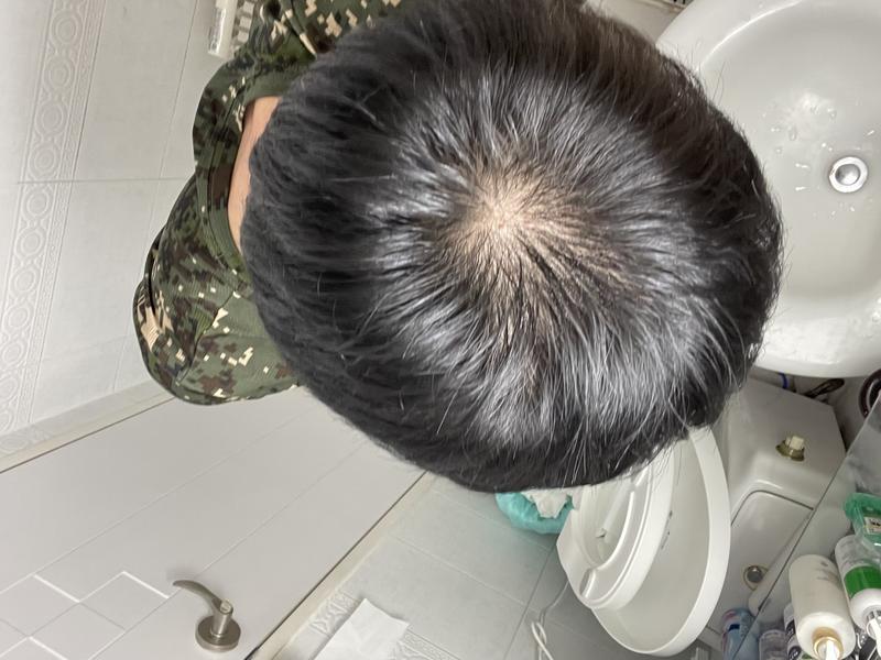 정수리탈모 괜찮아질까?