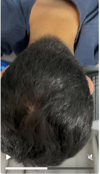 머리 눌림