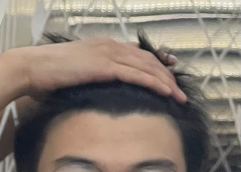 20살 재수생 탈모 고민(장문)