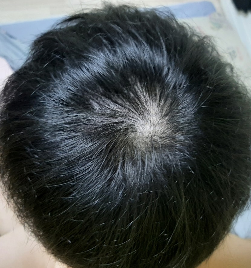 8개월 전 삭발 전