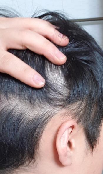 사진1>이 사진을 보면 유전 탈모의 영향을 받지 않는 옆머리와 뒷머리도 굉장히 숱이 적은 것을 알 수 있지, 난 타고나기를 머리숱이 적게 태어났어.