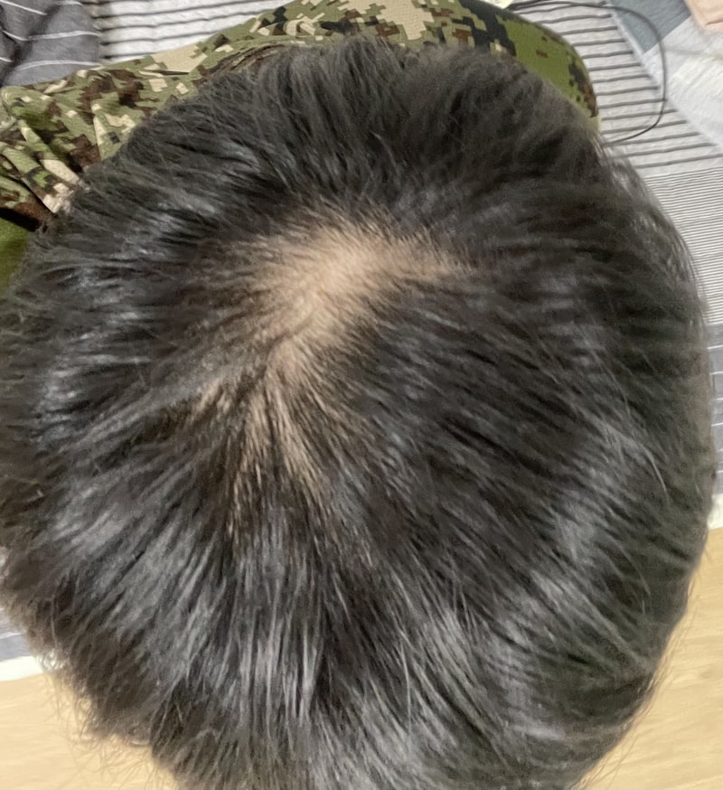 탈모약 7개월째 복용중인 23살 입니다...