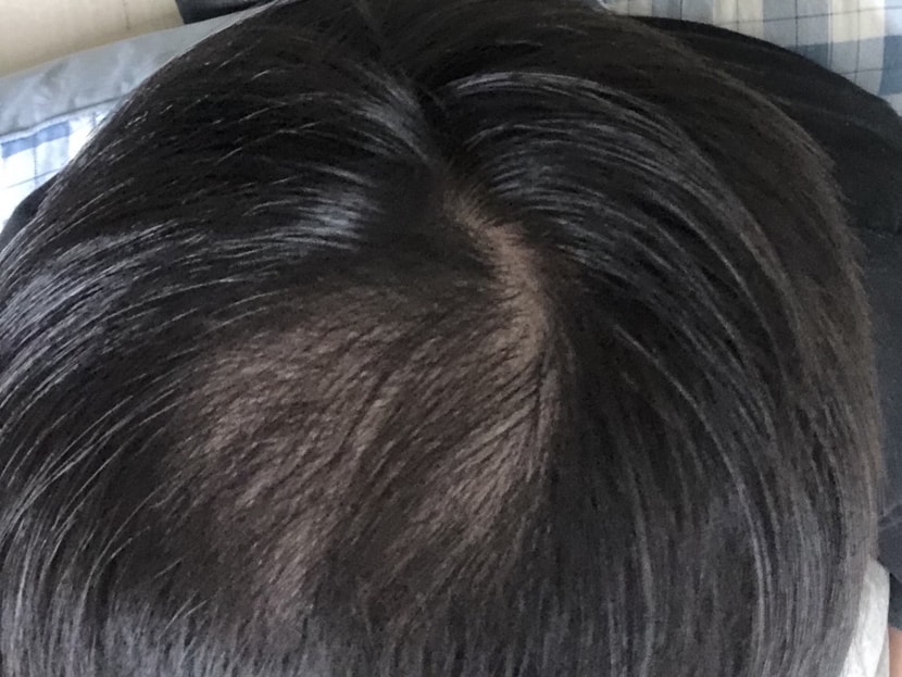 형광등아래 정수리 확대사진