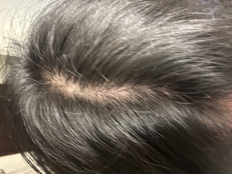 19-23세이른탈모