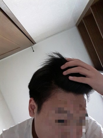 왼쪽 이마 끝부분