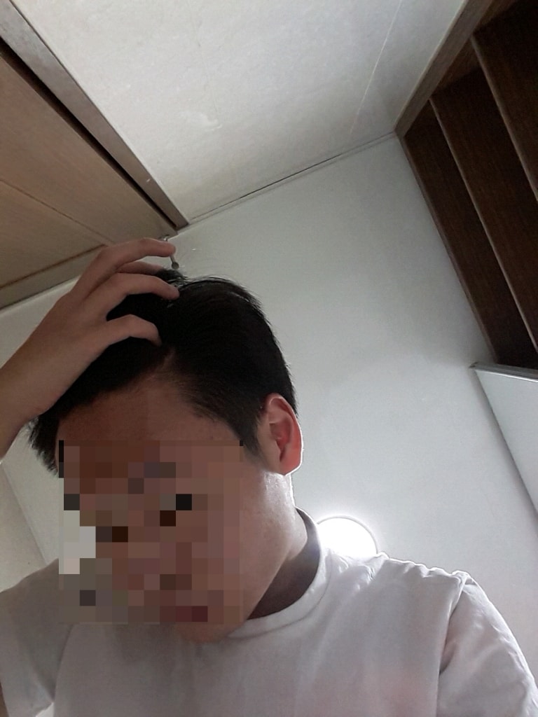 오른쪽 이마 끝부분