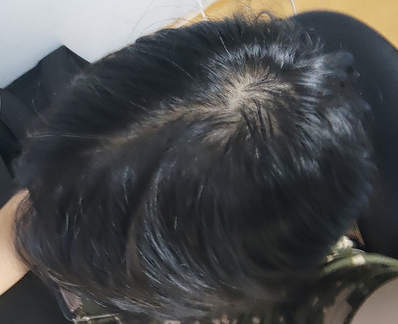 정수리 탈모 심해보이나요?
