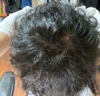 핀페시아 복용 120일 차