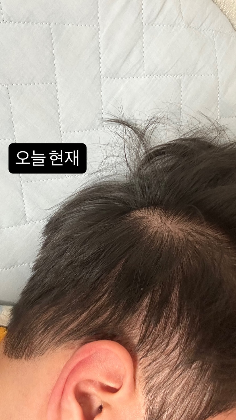 옆, 뒷머리 숱도 같이 동시에 빠졌어요