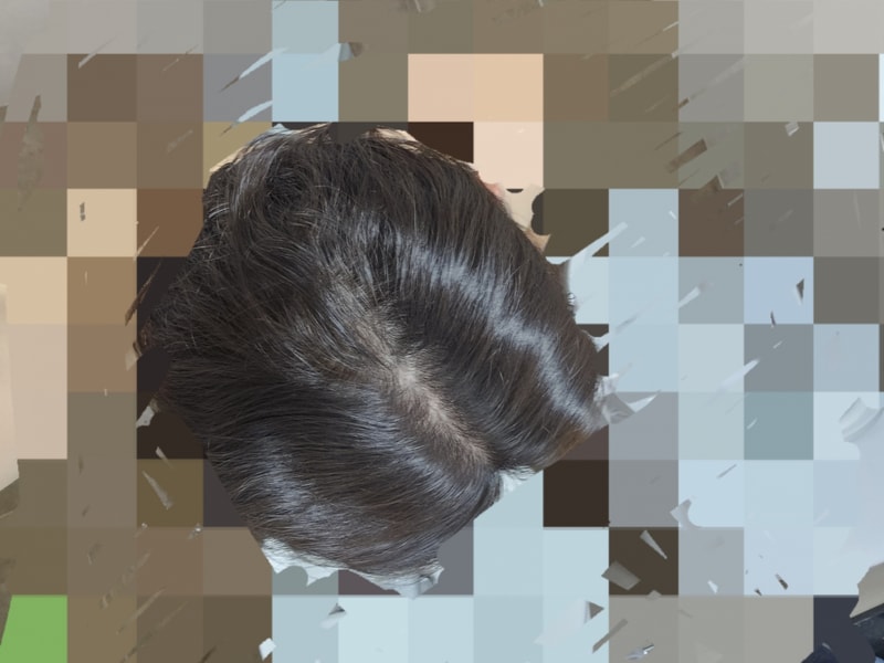 30살 아재 20대 초부터 탈모약 장기 복용 후기