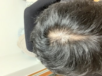 전체적인 앞머리쪽 숱 상태와 정수리 탈모진행상태