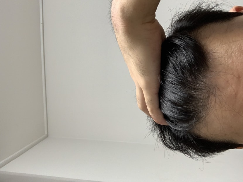 m자 탈모 진행상태