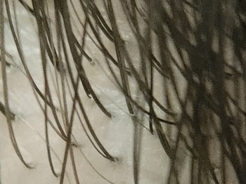 호르몬 영향 없는 뒷머리 확대 사진 2