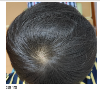 2024년 2월 정수리 사진