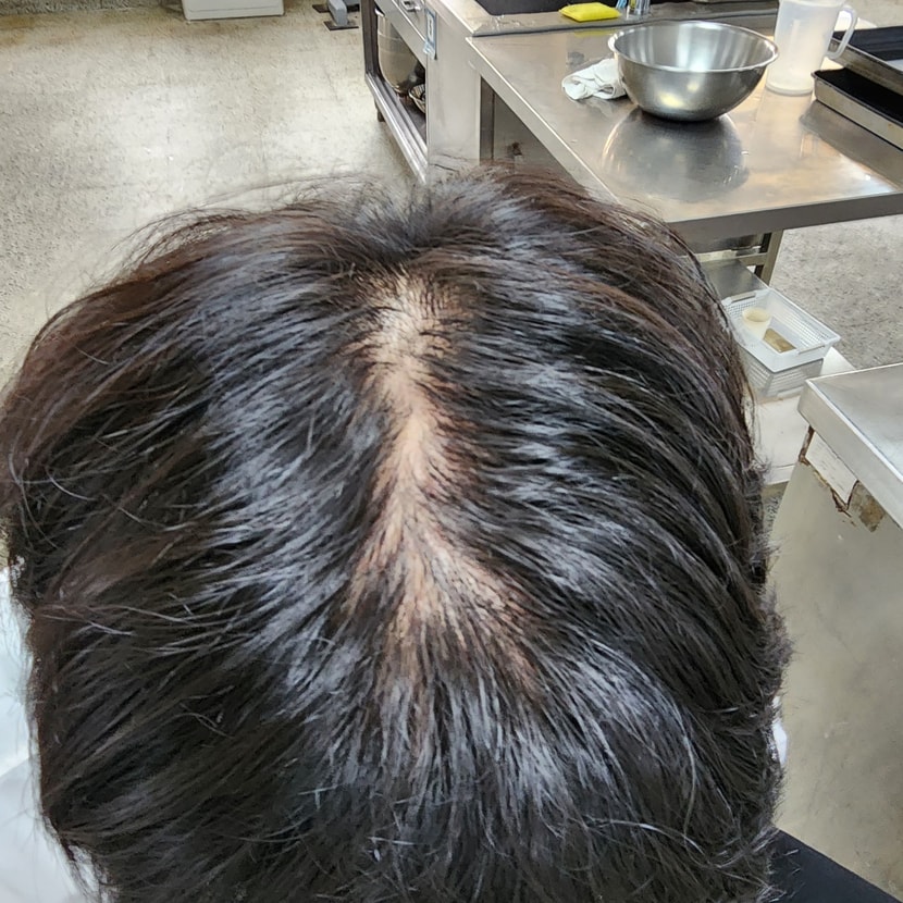 정수리 탈모에 지루성 두피염 입니다. 시술을 해볼까요 아니면 약을 먹을까요